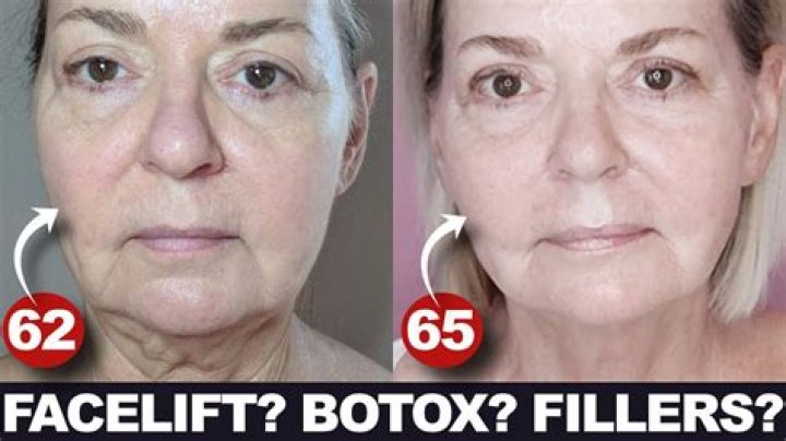 Did Carol Burnett Have Plastic Surgery? Fans Curious About Botox And Facelift