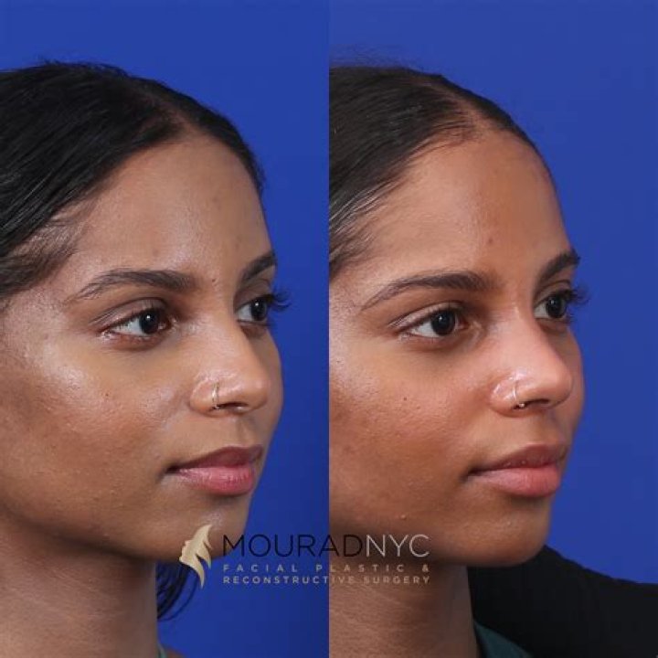 John Legend Plastic Surgery: Botox And Nose Job Before And After