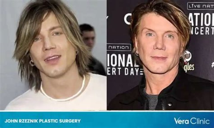 John Rzeznik Facelift: Goo Goo Dolls Frontman Plastic Surgery Before And After