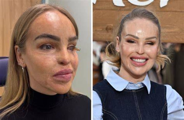Katie Piper is down with a bad infection and also has some eye irregularities!