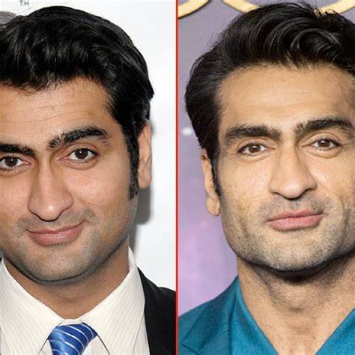 Kumail Nanjiani Jaw Surgery | Plastic Surgery Before And After Photos