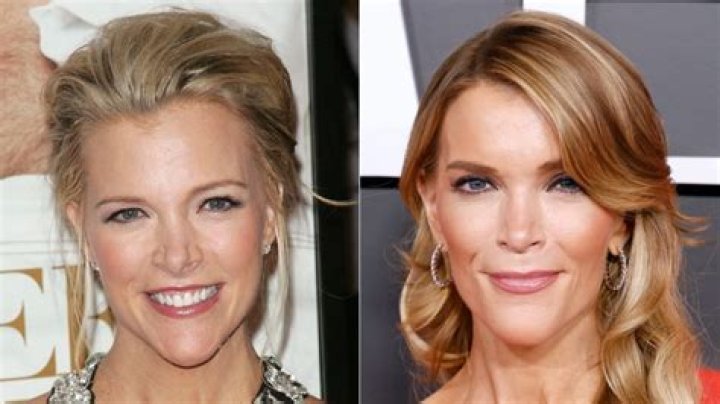 Megyn Kelly Facelift – Did She Get Plastic Surgery? Before And After Pics And Age