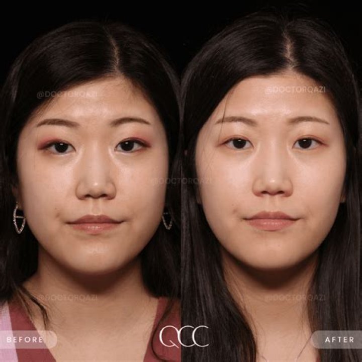 Mehgan James Plastic Surgery Nose Job And Botox Before And After