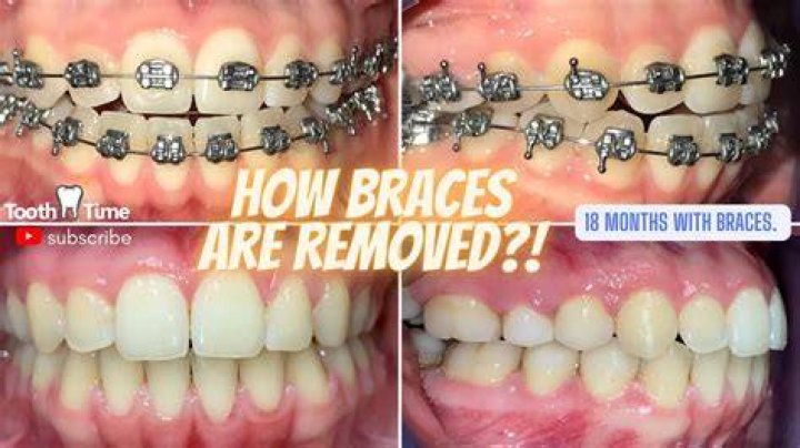 Randy Orton Missing Teeth Case: Is He Toothless Now? Used Braces