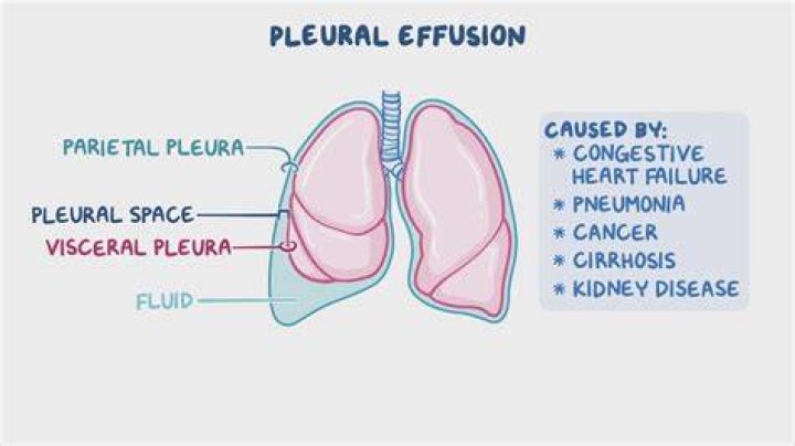What causes unilateral pleural effusion?