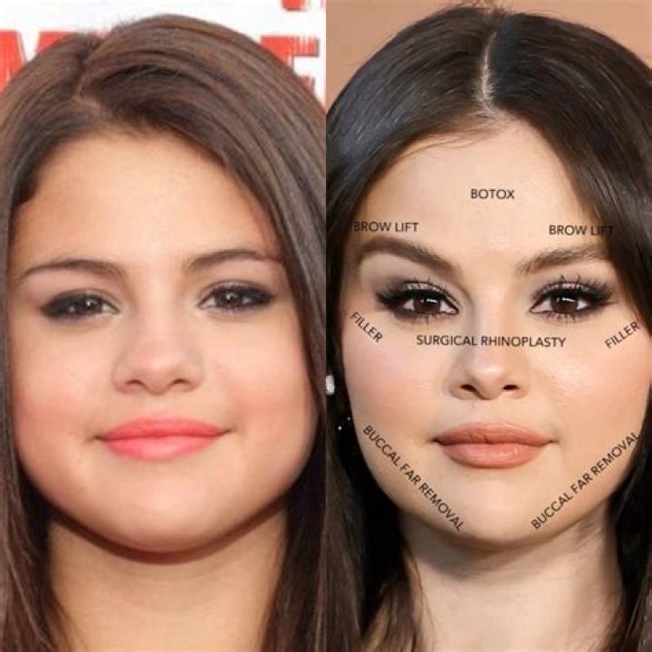 What Happened To Susanna Gibson Face? Plastic Surgery Botox Before And After Photos
