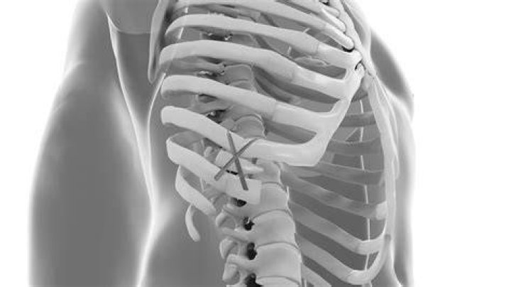 What is a compressed rib?