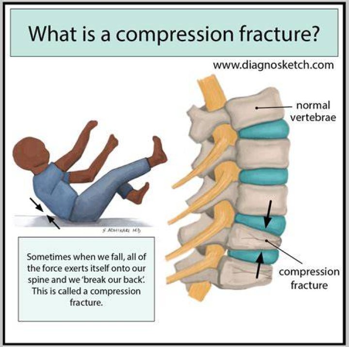 What is the ICD 10 code for l2 compression fracture?
